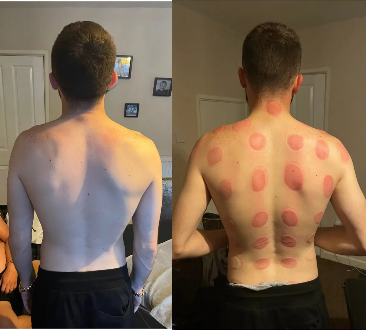Comparison of a client's back before treatment and immediately after cupping therapy