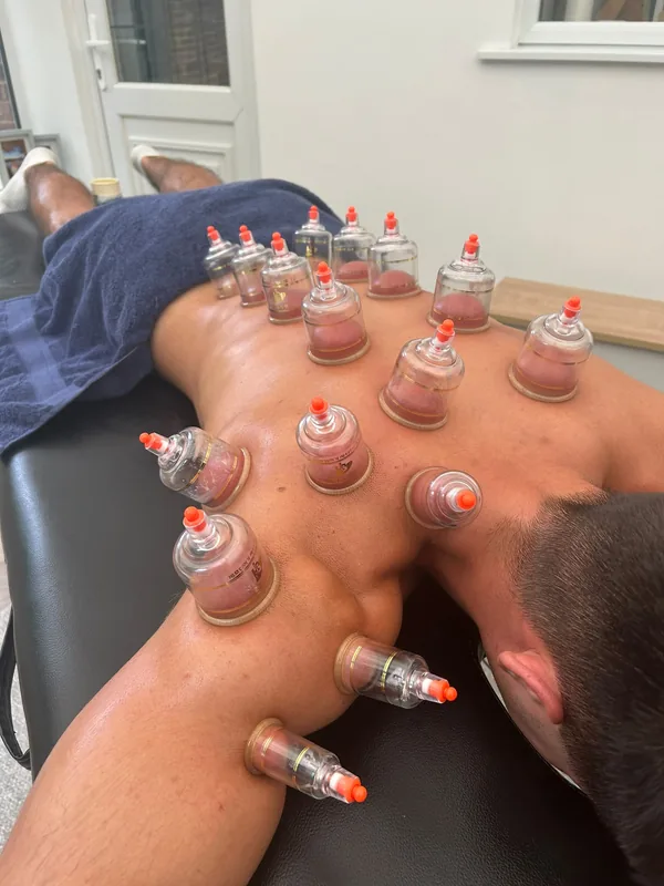Cupping cups placed across a client's upper back during a treatment
