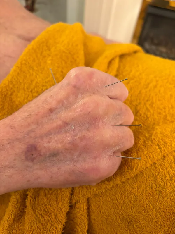 A single fine needle placed in the back of a client's hand