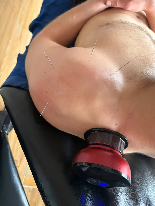Acupuncture needles and a suction cup working the same shoulder