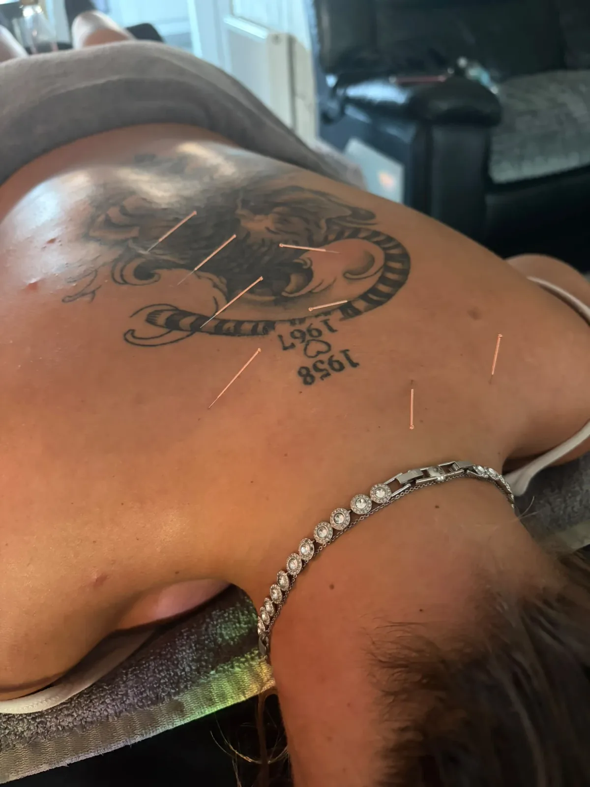 Fine acupuncture needles placed across a client's upper back and shoulder