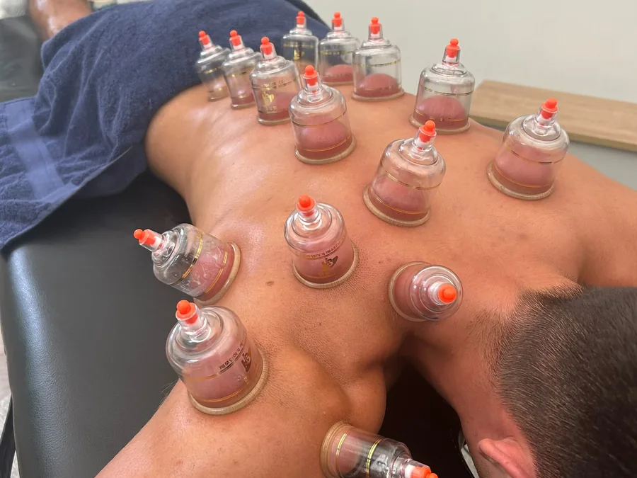 A set of cupping cups placed across a client's upper back and shoulders
